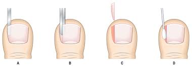 Surgical treatment of ingrown nail