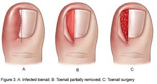 Wedge resection of nail