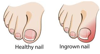 healthy nail and ingrown nail