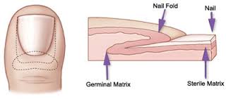 ingrown toe nail anatomy