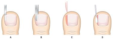 ingrown toe nail phenol
