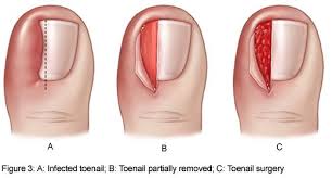 ingrown toe nail wedge resection