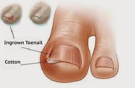 ingrown toe nail with pledget